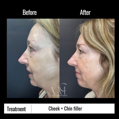 Cheek--Chin-B-+-A