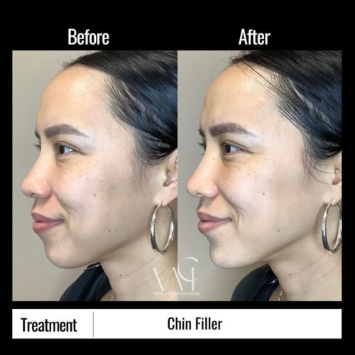 Chin-Filler-BA-Side