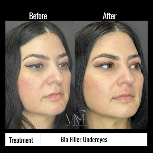 EZGel-undereye-BA-Side