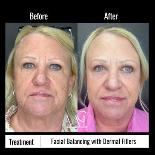 Facial-Balancing-BA-Front