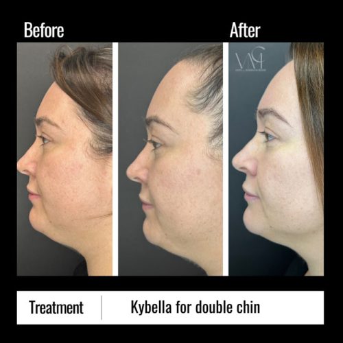 KybellaChin-BA-side