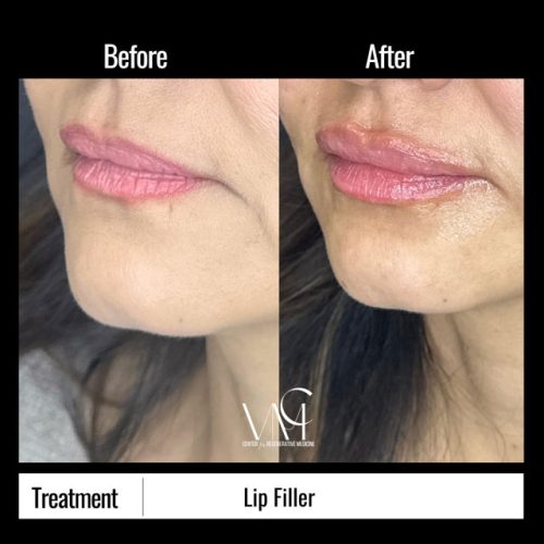 Lip-Filler-BA-Side