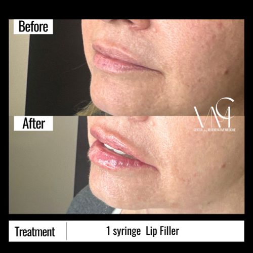Lip-Filler-BA-Side2