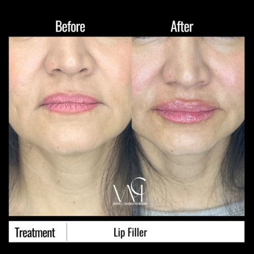 Lip-Filler-BA