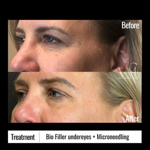 Microneedling--Biofiller-B+A-side