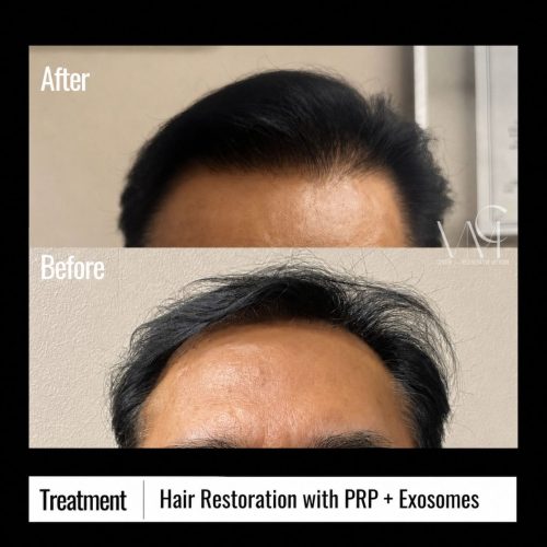 PRP--Exosomes-Hair-B+A-Front
