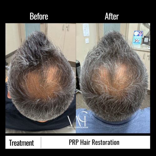 PRP-Hair-BA-Top
