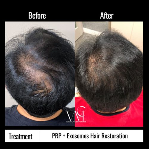 PRPExo-Hair-B+A-Top
