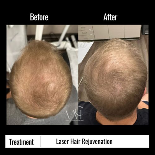 UltraLaser-Hair-BA-Top