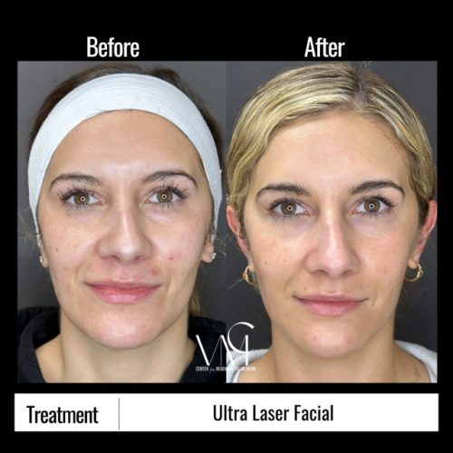 Ultralaser-BA-Front